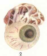 меланома очі