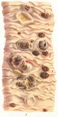 меланома кишечника