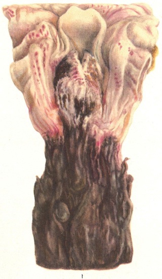 меланозу стравоходу