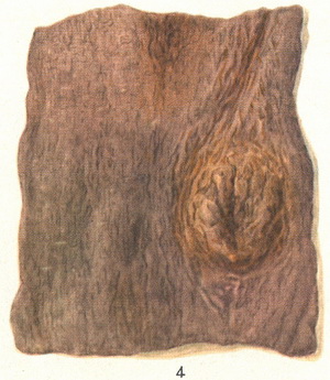 меланозу шкіри