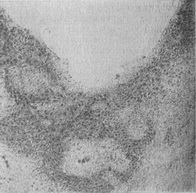 продуктивний туберкульозний эпендиматит