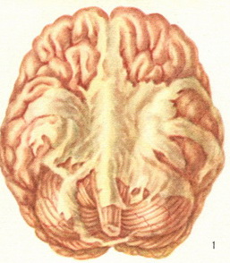 туберкульозний ексудативний базилярний лептоменингит