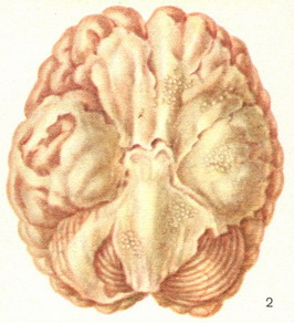 туберкульозний продуктивний базилярний лептоменингит