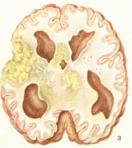 туберкульозний менінгоенцефаліт