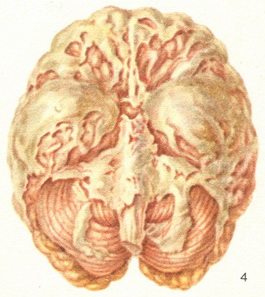 epidemic cerebrospinal meningitis