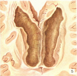 епідемічний цереброспінальний менінгіт