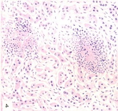 міліарні гуми печінки
