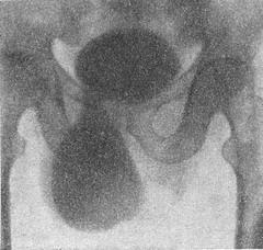 пахово-мошоночная грижа сечового міхура