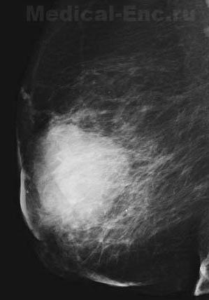 рак молочної залози