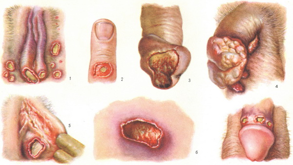 м'який шанкр фото