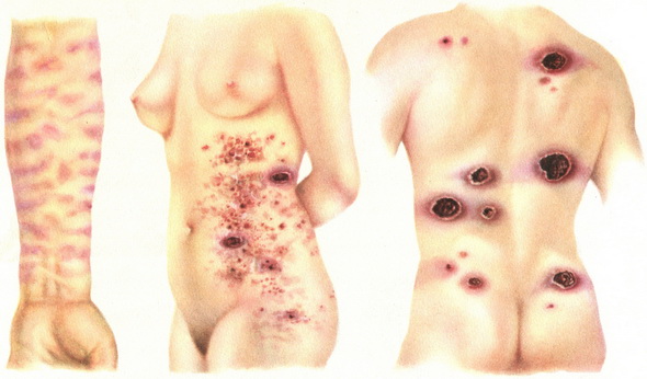 грибоподібний мікоз