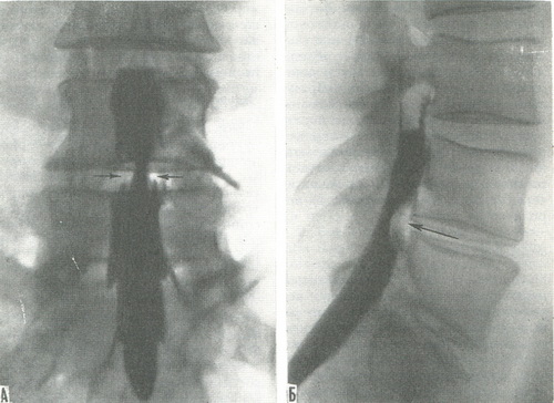 мієлограми