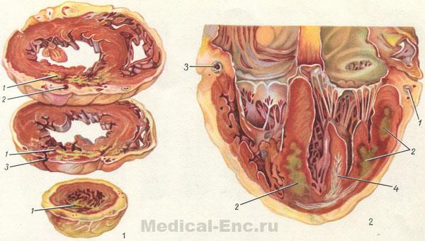 нфаркт міокарда