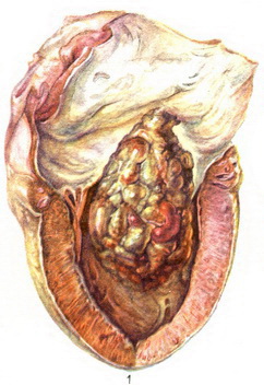 міксома лівого передсердя
