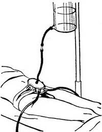 надлобковая капсула