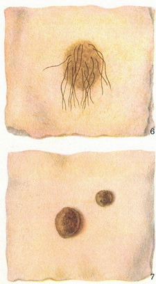 пігментний невус