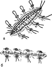 накладення шкірних швів при эвентрации