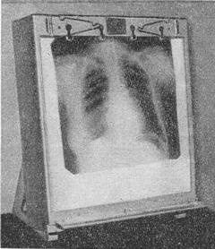 негатоскоп