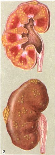 апостематозний нефрит