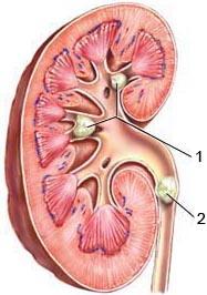 камені в нирках