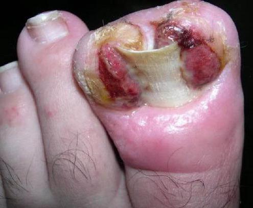 врослий ніготь