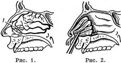 носова кровотеча