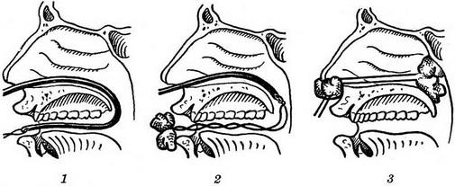 як зупинити кров з носа