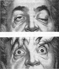 хронічна прогресуюча зовнішня офтальмоплегія