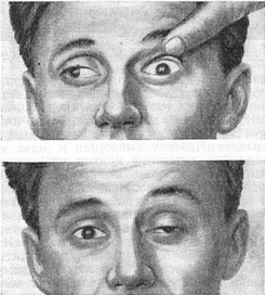 хронічна одностороння зовнішня офтальмоплегія