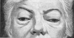 экзофтальмическая офтальмоплегія