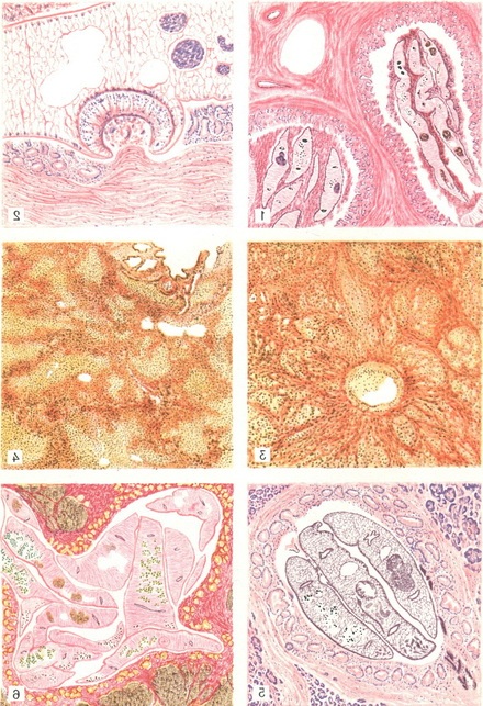 описторхозы