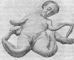 остеомаляція