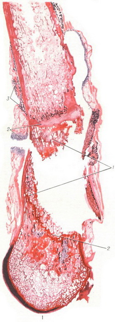 вогнепальний остеомієліт