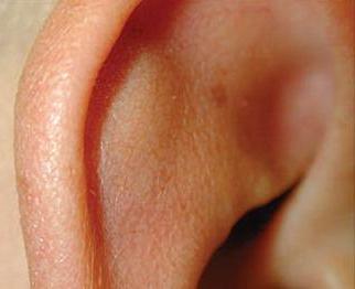 отгематома.