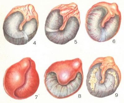 гострий середній отит