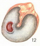 хронічний гнійний середній отит