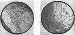 відшарування сітчастої оболонки