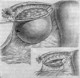 резекція фолікулярної кісти яєчника