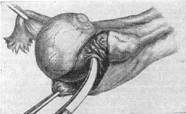 вылущение кісти яєчника
