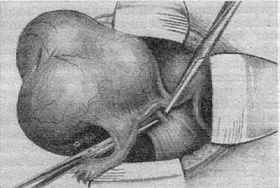 овариотомия