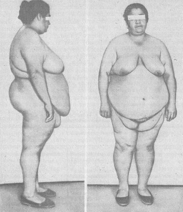 ожиріння IV ступеня