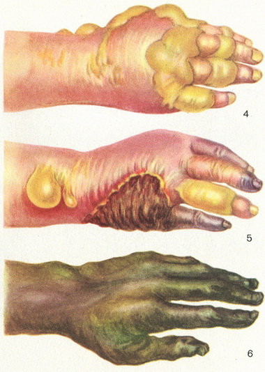 класифікація опіків