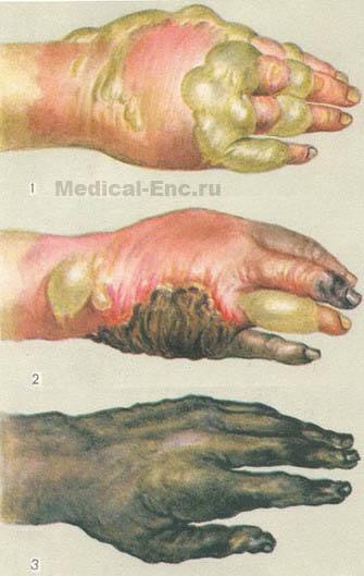 термічні опіки
