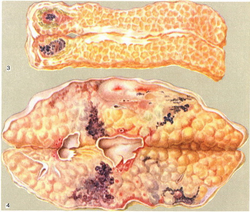 панкреатит