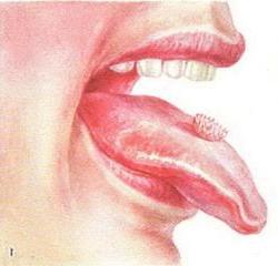 папілома мовою