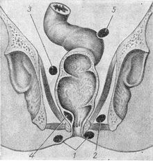 основні види парапроктитов