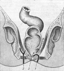 основні форми нориць