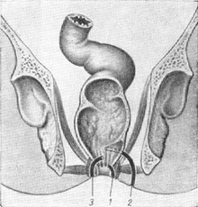 ставлення каналу свища до сфинктеру