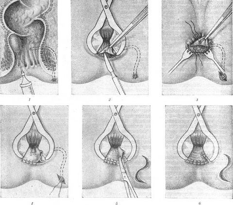 операція Блинничева при глибокому внесфинктерном свище