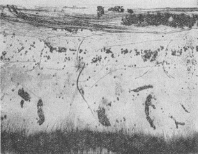 пародонтоз